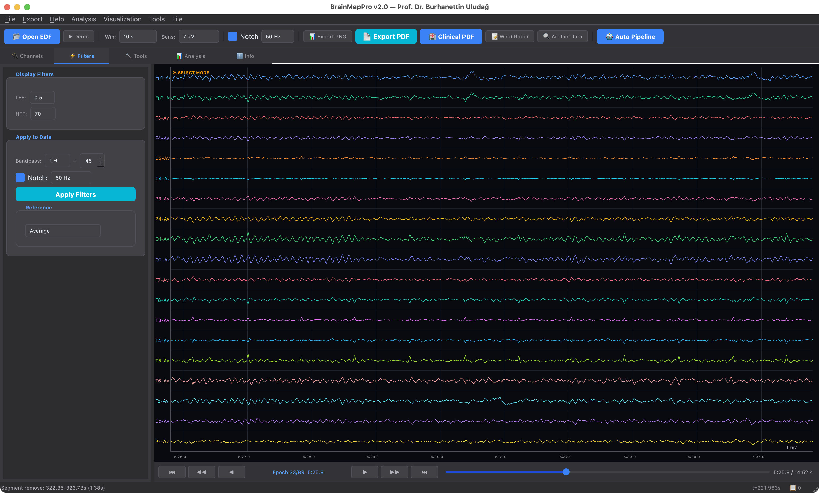 Bandpass and notch filter controls