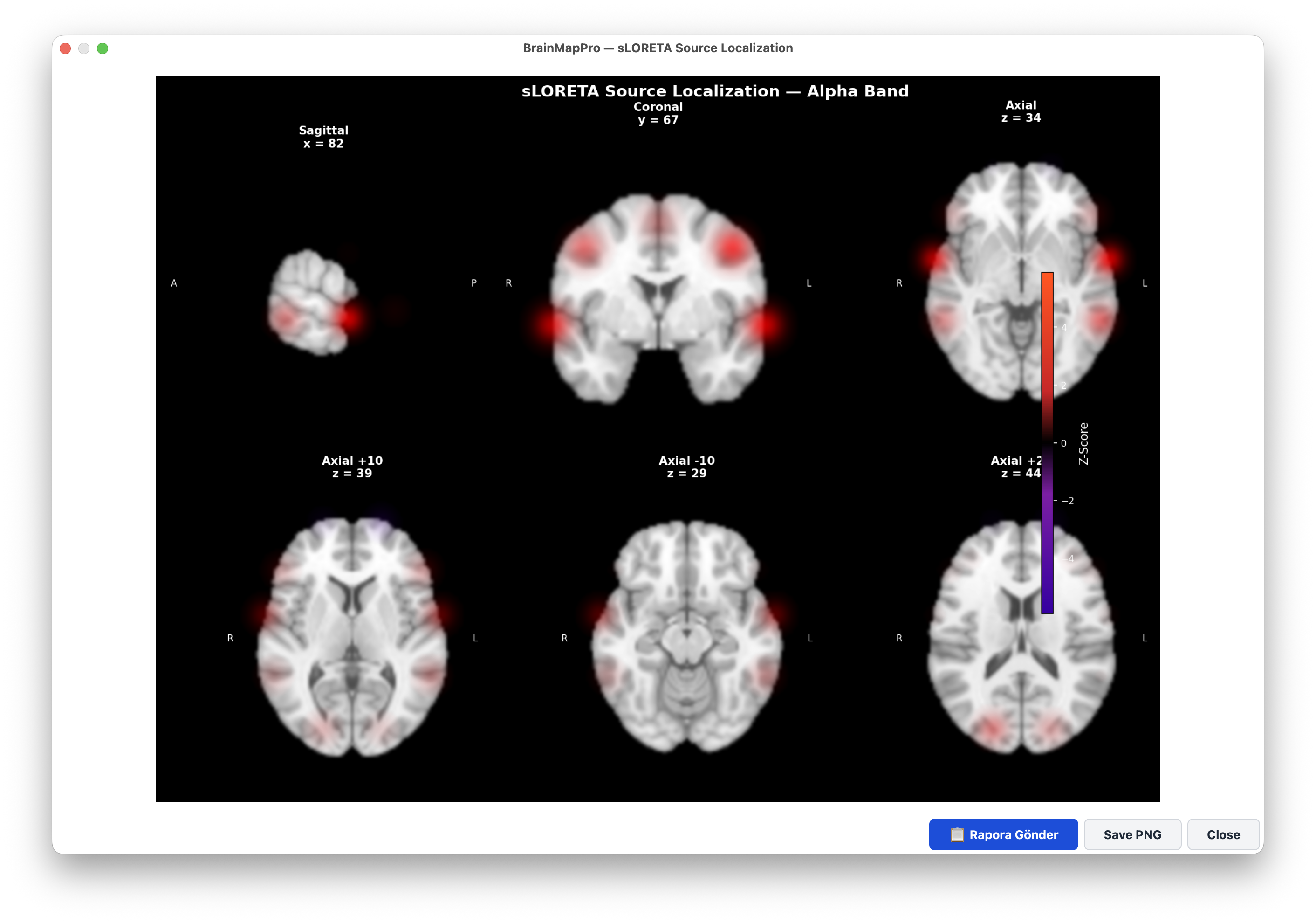 sLORETA source localization on MRI brain slices
